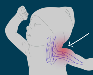 How Brachial Plexus Damage Caused During Delivery Affects a Child’s Development in Ways Parents Often Miss
